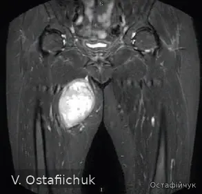 MRI of a soft-tissue mass