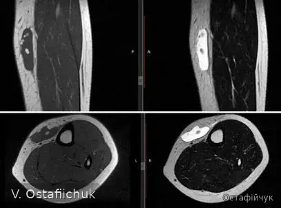 Multiplanar MRI of a soft-tissue mass