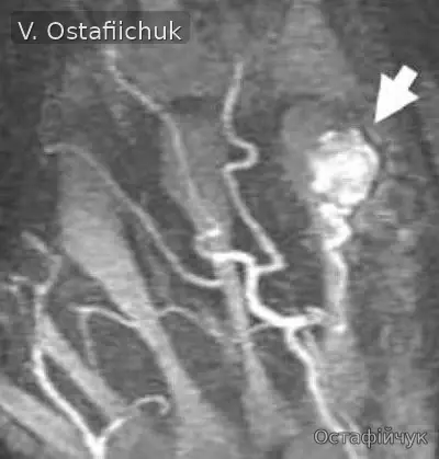 Vascular imaging for a soft-tissue tumour