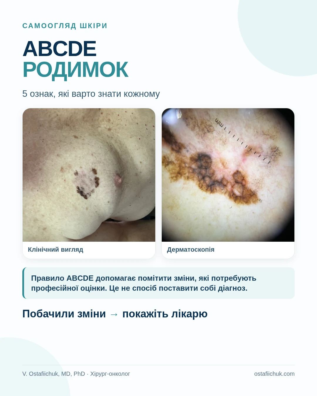 Правило ABCDE для самоогляду підозрілих родимок