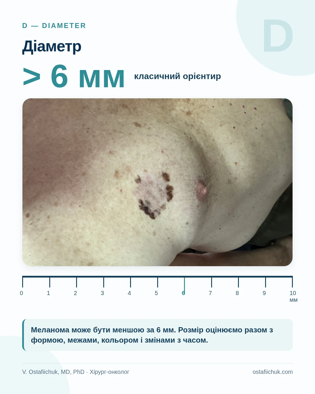 Діаметр пігментного утворення та орієнтир 6 мм у правилі ABCDE