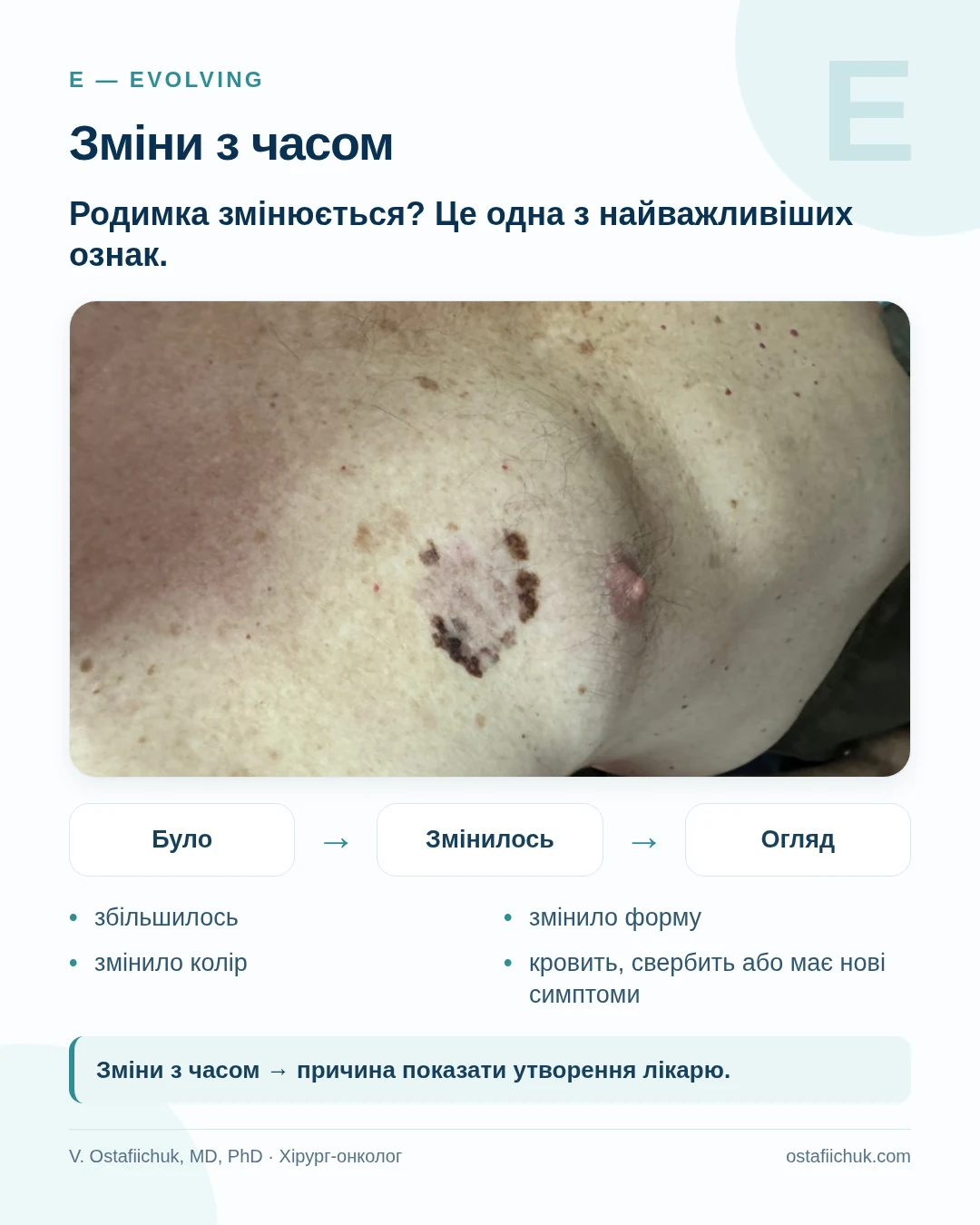 Зміни пігментного утворення з часом як ознака E у правилі ABCDE