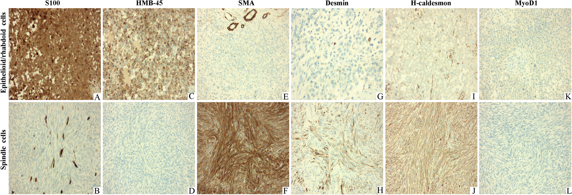 Immunohistochemistry of sinonasal melanoma